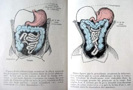 Déformation des organes par le corset