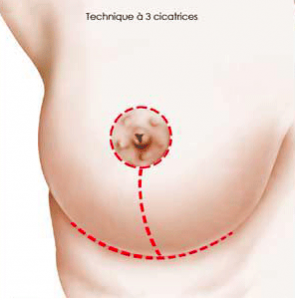 cicatrices réduction mammaire
