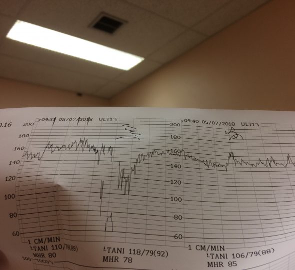 Monitoring avec une anomalie du rythme cardiaque foetal